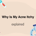 Why Is My Acne Itchy