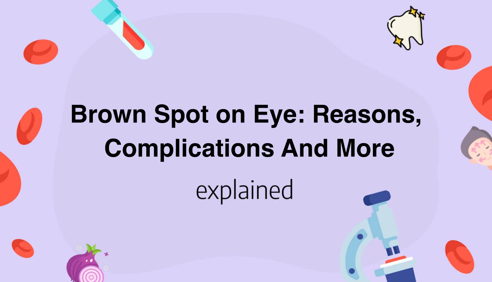 brown-spot-on-eye-reasons-complications-and-more