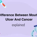 Difference Between Mouth Ulcer And Cancer