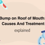 Bump on Roof of Mouth: Causes And Treatment