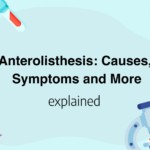 Anterolisthesis: Causes, Symptoms and More