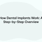 How Dental Implants Work: A Step-by-Step Overview
