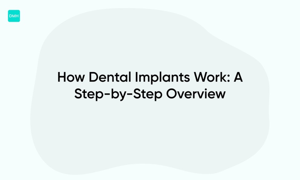 How Dental Implants Work: A Step-by-Step Overview